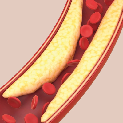 Gordura no sangue
